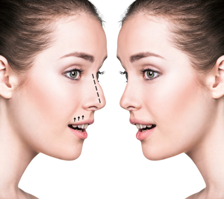 Chirurgie du nez Rhinoplastie